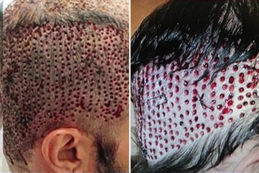 Side effects of FUE hair transplant
