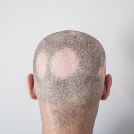 Alopecia head