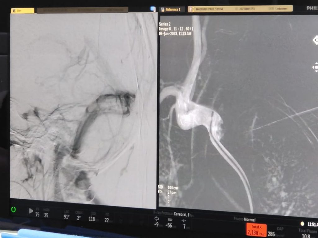 First Angiography in SMCh by Sambuddha Dhar